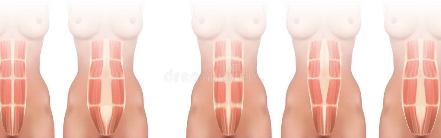 diastasis abdominal